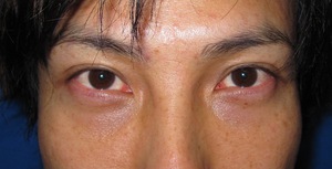 目の下のたるみ、目のくまでお悩みの方、切らずに完璧に解決します。TCB-R法　手術直後　症例写真